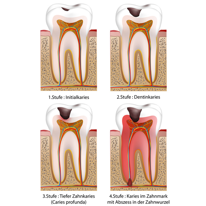 Karies in vier Stufen